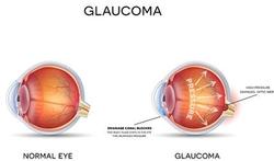 Kunt u glaucoom preventief laten opsporen?