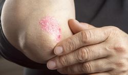 Wereld Psoriasisdag: 13 wintertips voor psoriasis