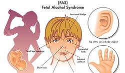 Het foetaal alcohol syndroom (FAS)