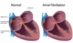 Nieuw dossier: Voorkamer- of atriumfibrillatie: de meest voorkomende hartritmestoornis