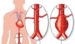 Het aneurysma