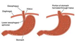 Nieuw dossier: Een maagbreuk of hernia van het middenrif