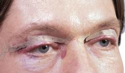 Ooglidcorrectie (Blepharoplastiek)