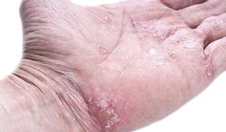 Wintertips voor psoriasis