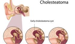 Nieuw dossier: Cholesteatoom: een agressieve middenoorontsteking