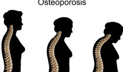 Test jezelf: Osteoporose-test