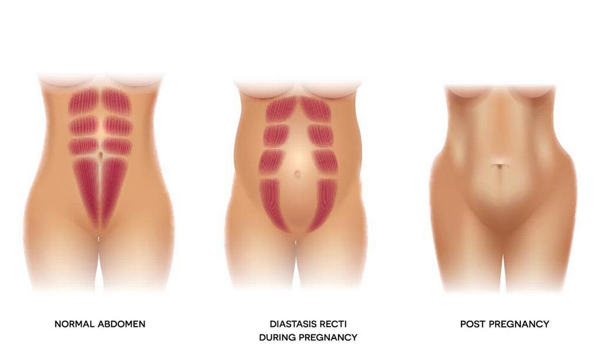 Diastase Na Zwangerschap Wat Kan Je Doen Gezondheid Be