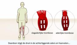 Video: Trombose