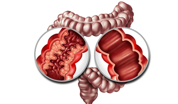 Ziekte van Crohn en Colitis Ulcerosa | gezondheid.be